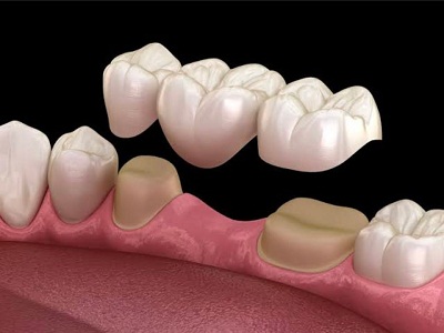 Replacement of Missing Teeth