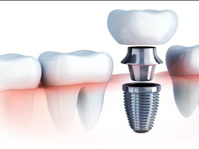 Dental Implants