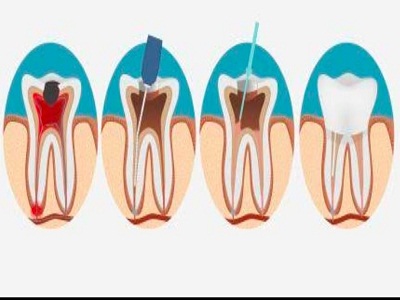 Root Canal Treatment