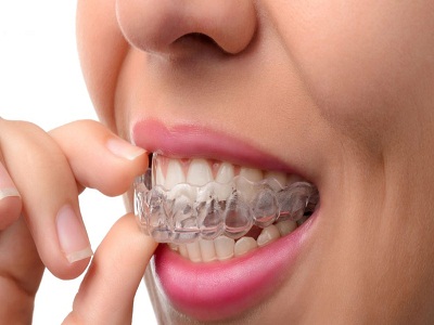 Teeth Alignment