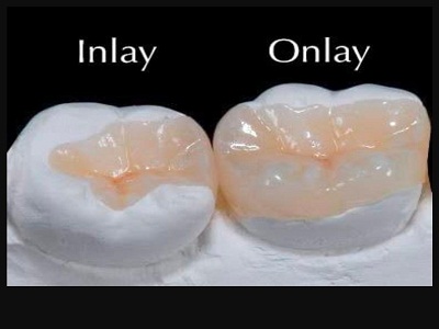 Dental Fillings