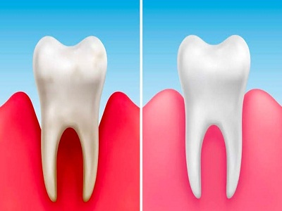 Gum Treatments