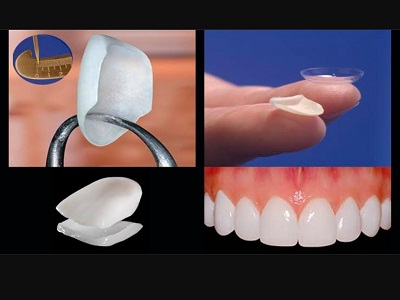 Veneers