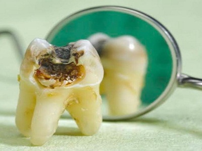 Dental Bridges